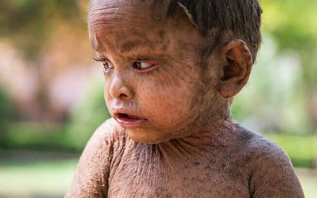 Bebê indiana sofre de condição rara que faz com que sua pele tenha escamas como as de um lagarto
