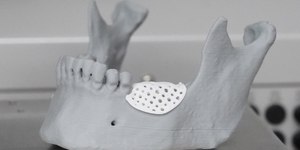 Enxertos impressos em 3D revolucionam a reconstrução óssea