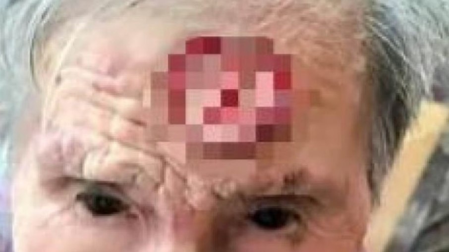 Avó chinesa corta 'chifre da longevidade' da testa com tesoura; precisa de cirurgia de emergência