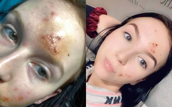 Após perceber queimadura no rosto, Natasha foi orientada por médicos a cuidar da pele usando apenas água