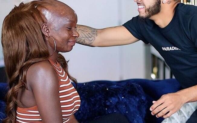 Shalom desenvolveu amor pela maquiagem e encontrou na internet um refúgio para lidar com as marcas da queimadura