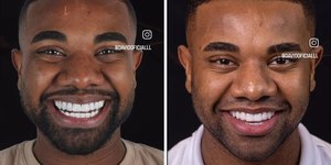 Davi Brito muda lentes dos dentes em transformação de R$ 60 mil
