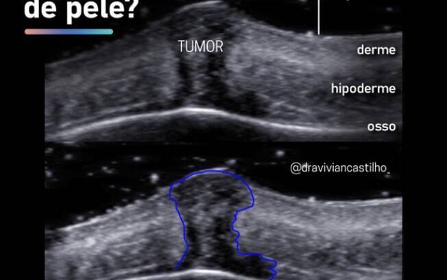 Preenchedores estéticos e câncer de pele podem ser diagnosticados em exame