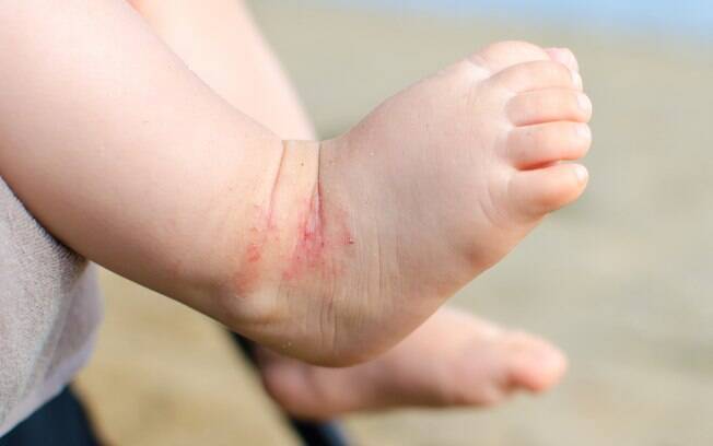 Dobrinhas do corpo de bebês favorecem contato da pele com o suor, mais produzido no calor, favorecendo alergias de pele