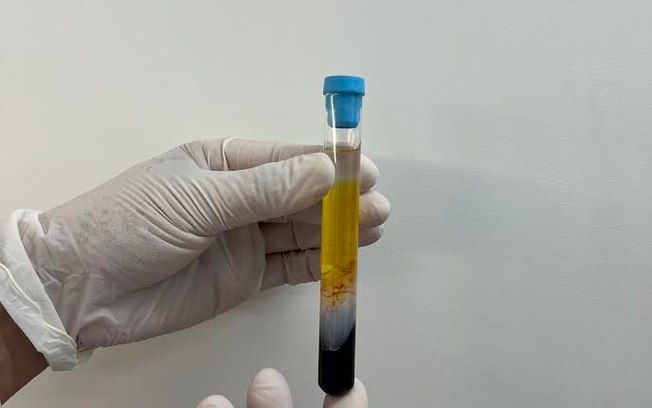 CFM regulamenta PRP em condições osteomusculares