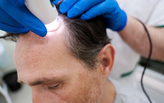 Terapias clínicas não cirúrgicas ativam crescimento capilar Terapias clínicas não cirúrgicas ativam crescimento capilar