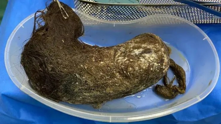 S%C3%ADndrome%20de%20Rapunzel%3A%20crian%C3%A7a%20retira%20bola%20de%20cabelo%20do%20est%C3%B4mago