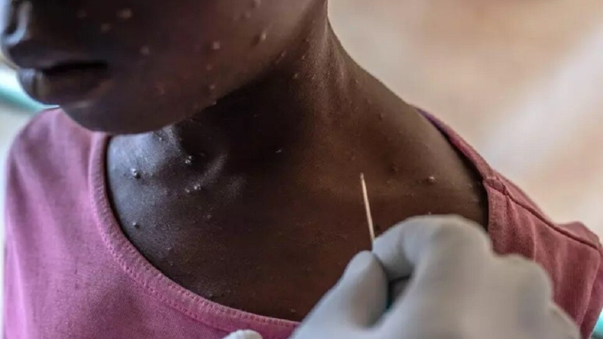 Vacina brasileira contra a mpox está próxima dos testes em humanos