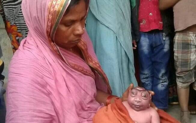 Mãe indiana dá a luz a bebê com doença rara e se recusa a amamentá-lo; criança é chamada de 