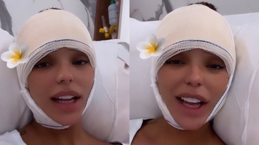 O que é a frontoplastia, cirurgia feita por Brunna Gonçalves para diminuir testa