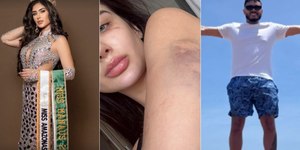 Agressor de Miss Amazonas foge de hospital para evitar prisão