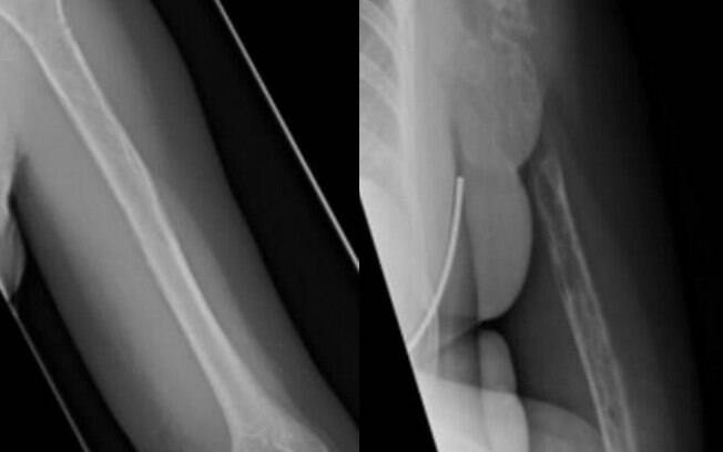 Na esquerda, um raio-x de seu braço um ano e meio antes do diagnóstico da doença do osso fantasma, na segunda imagem