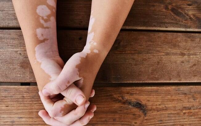 Vitiligo: conheça a doença que causa manchas brancas na pele