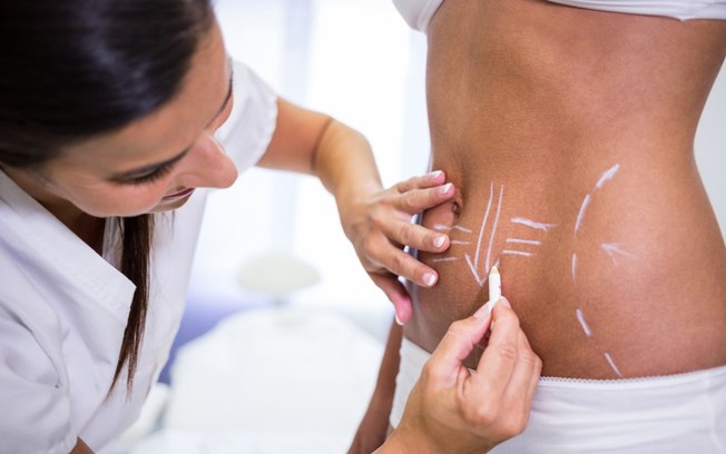 Lipo HD amplia possibilidades da definição corporal
