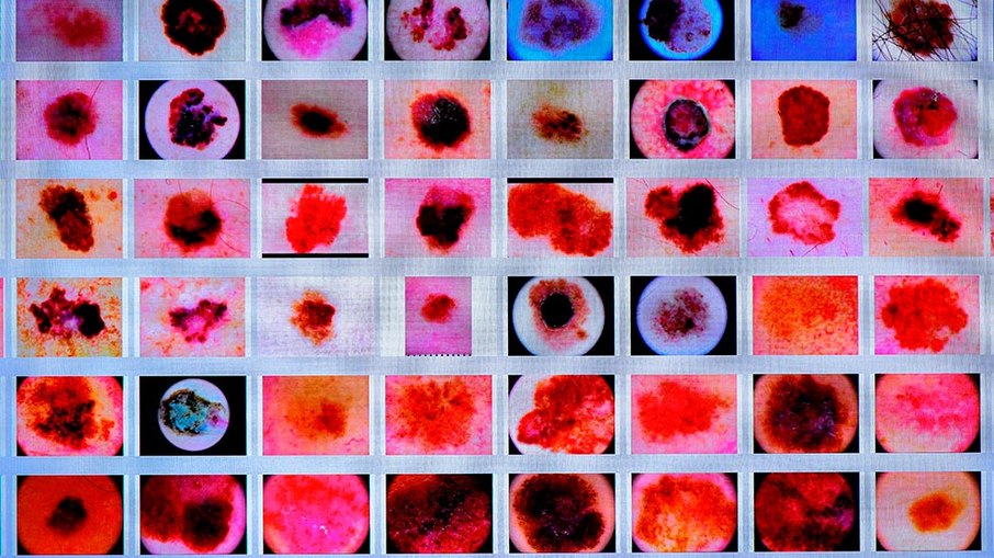 Imagens de lesões de pele que utilizam para treinar padrões de IA