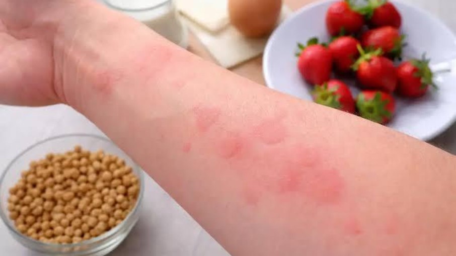 Alergia alimentar atinge até 8% das crianças no Brasil Alergia alimentar atinge até 8% das crianças no Brasil