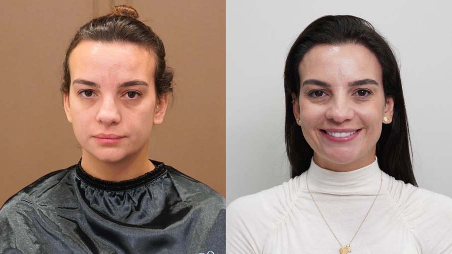 Talita Costella, de 34 anos, decidiu passar por transplante capilar porque se incomodava com 'testa alta' e 'entradas'; veja antes e depois