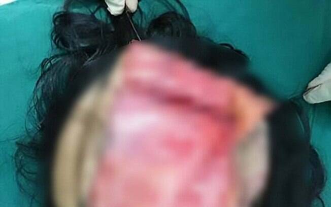 Médicos levaram oito horas para limpar o ferimento e costurar o couro cabeludo da mulher de volta na cabeça