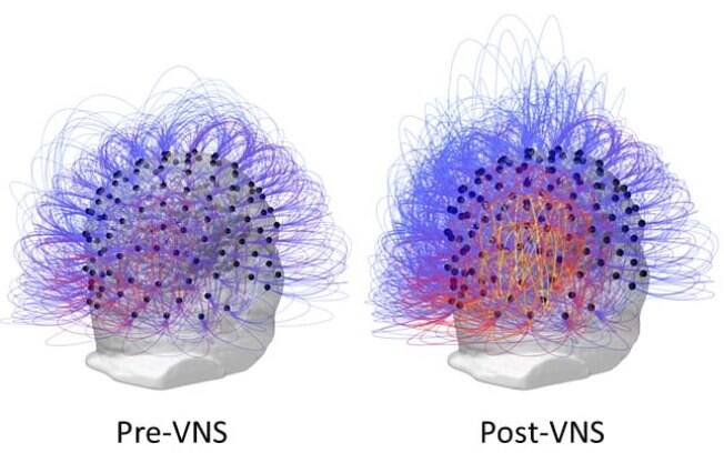 Estado vegetativo: À direita, as cores mais quentes indicam um aumento na conectividade após a estimulação do nervo vago