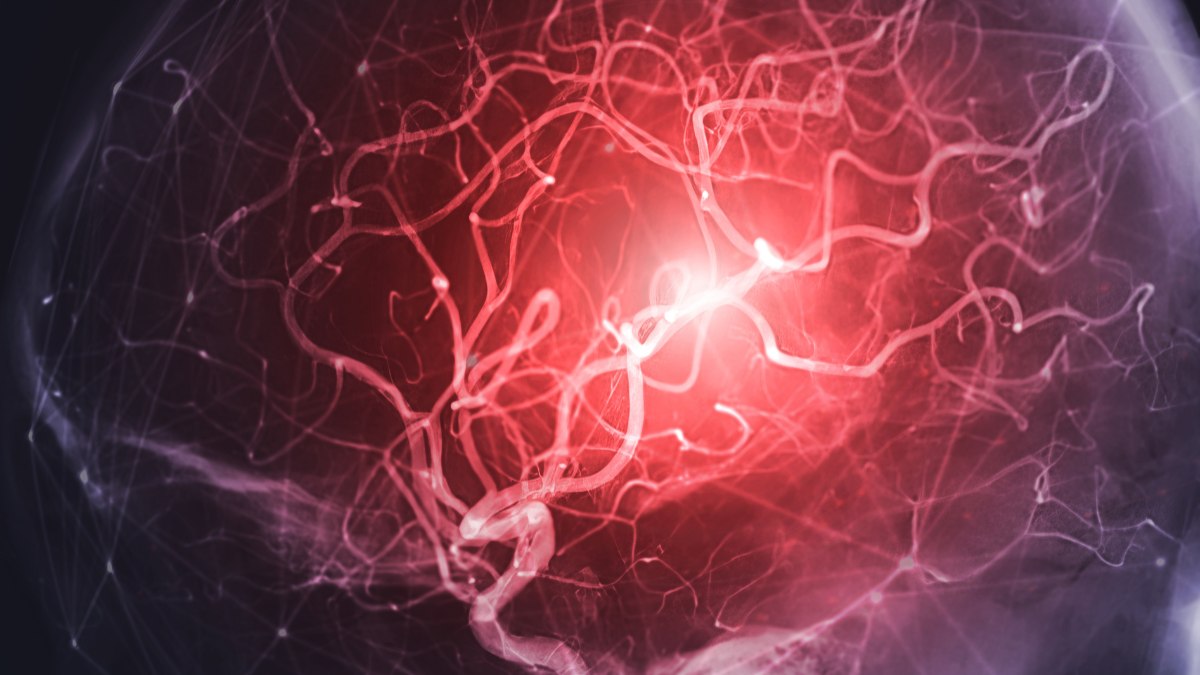 Aneurisma cerebral Aneurisma cerebral