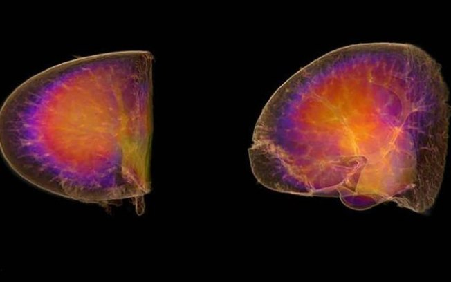 Doença renal cósmica: viagem a Marte pode causar danos aos rins