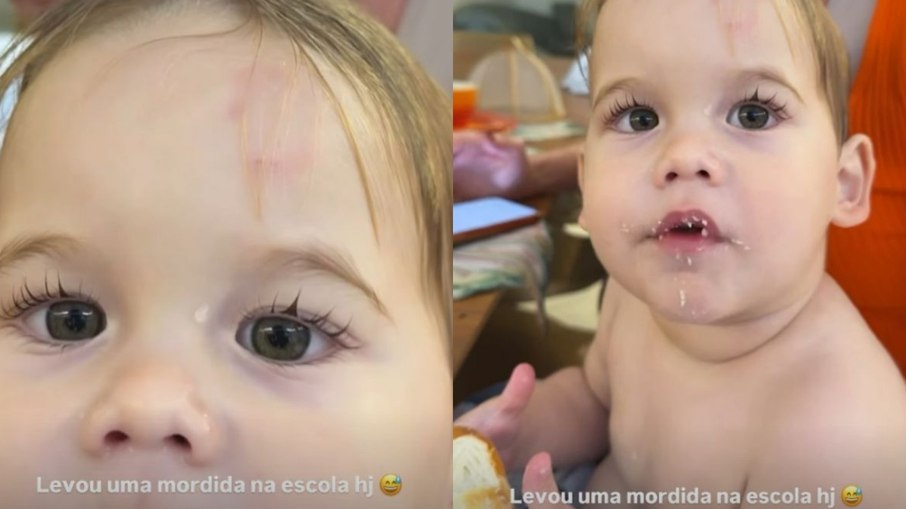 José Leonardo, filho de Virginia, leva mordida na testa