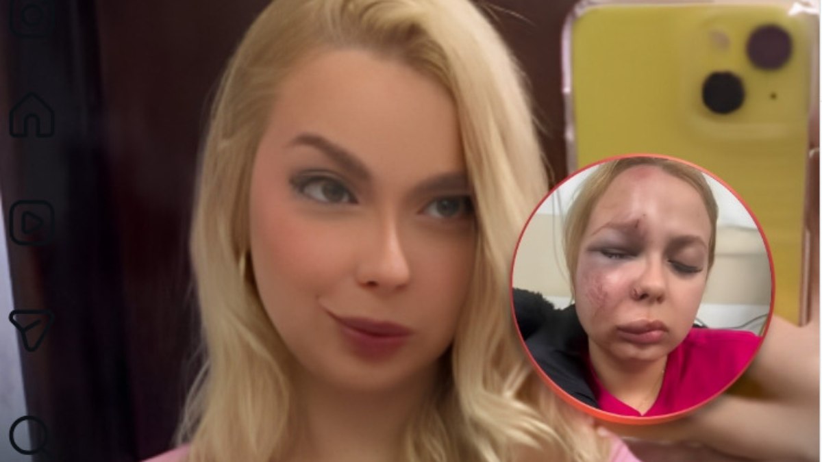 Larissa Raudenberg teve maxilar, nariz, joelho esquerdo e três dentes quebrados por desconhecido Larissa Raudenberg teve maxilar, nariz, joelho esquerdo e três dentes quebrados por desconhecido