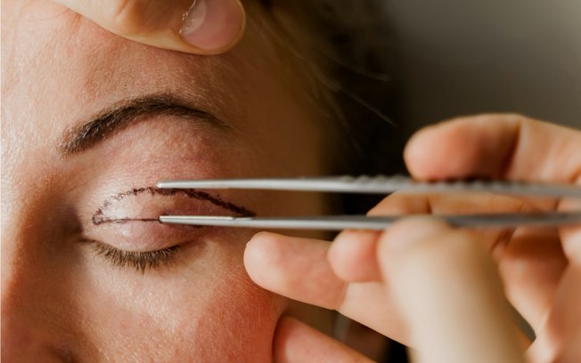 Blefaroplastia: procedimento que rejuvenesce o olhar