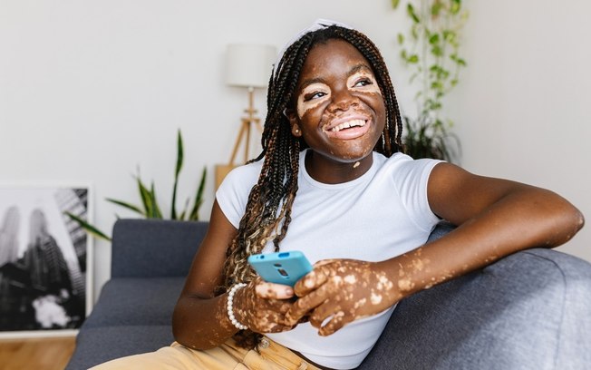Vitiligo: 3 cuidados fundamentais com a pele durante o verão