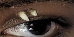 Jovem vai a hospital por inchaço e descobre dente em cima do olho