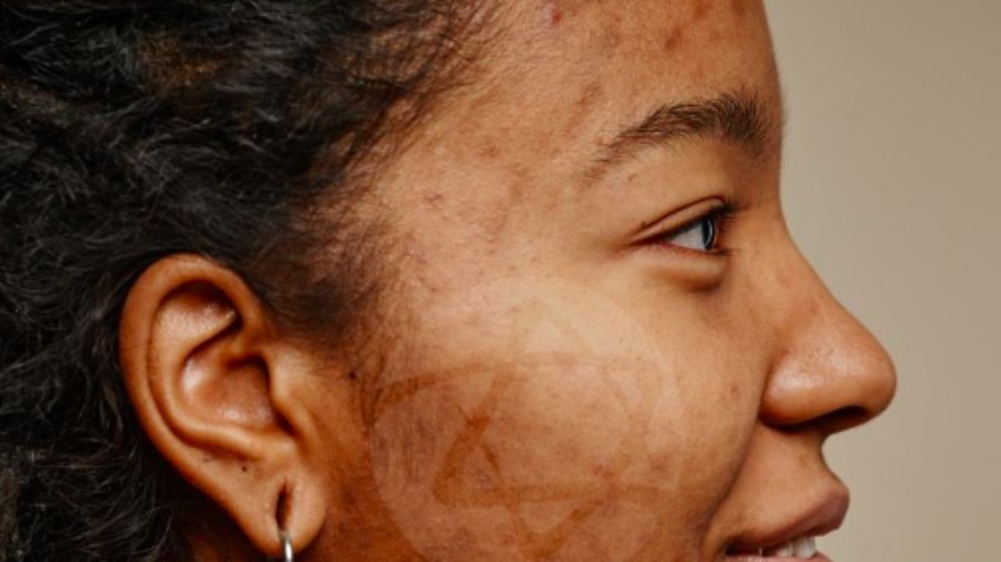 Pessoas com acne enfrentam preconceitos que  prejudicam vida social e profissional, mostra estudo