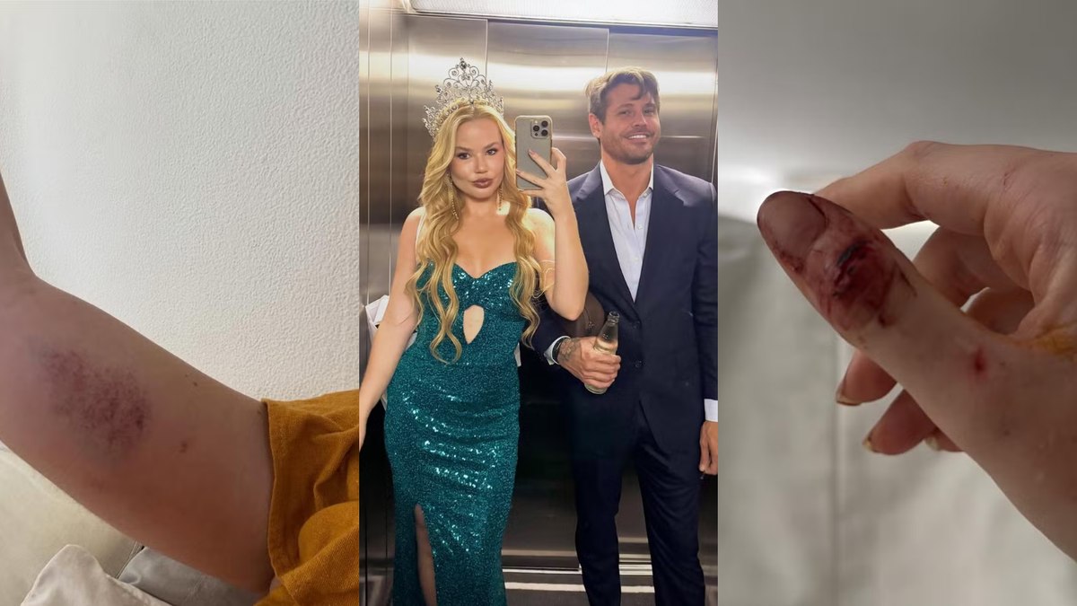 Ex de Dado Dolabella expõe fotos e diz que sofreu agressões