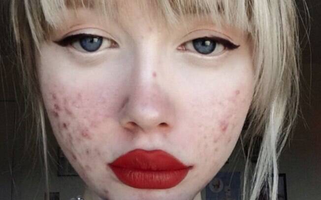 Aparência do rosto é apenas uma das preocupações de Hailey com a acne, já que o problema também causa dor