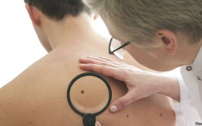 Câncer de pele melanoma apesar de ser mais raro, tem mais chances de causar mortes Câncer de pele melanoma apesar de ser mais raro, tem mais chances de causar mortes