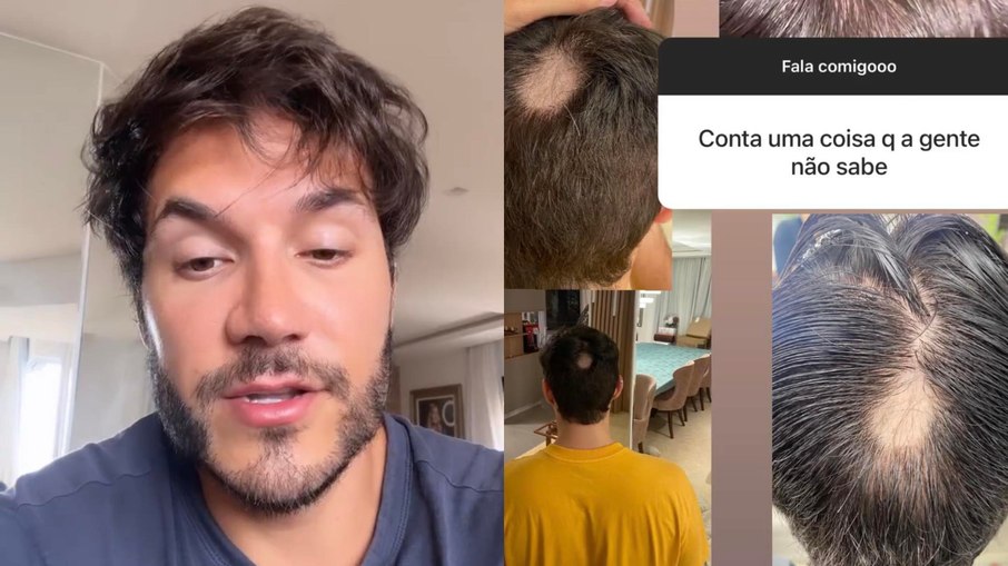 Eliezer conta que desenvolveu alopecia após anunciar a gravidez de Viih Tube