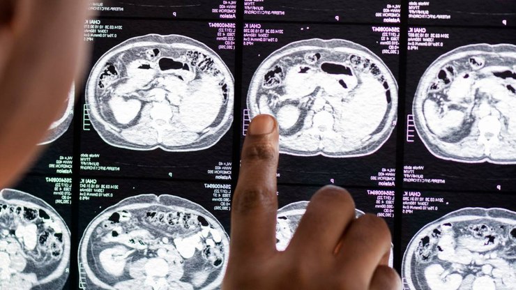 MOGAD: doença autoimune é rara e difícil de diagnosticar