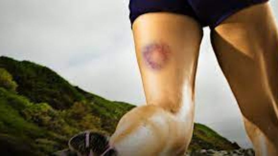 Manchas roxas pós-treino: quais os riscos de varizes se elas aparecerem nas pernas?