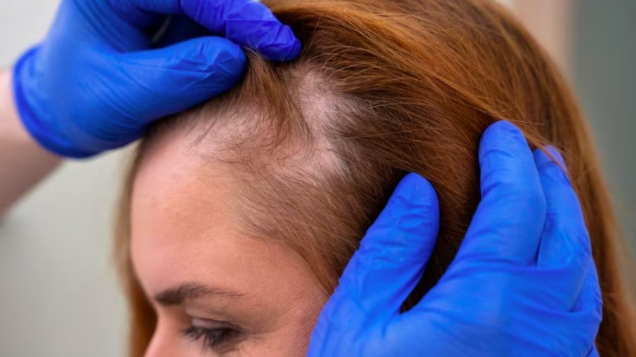 Entenda a técnica de transplante de cabelos para mulheres