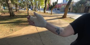 Mulher é atacada por pitbull ao proteger cachorra em praça