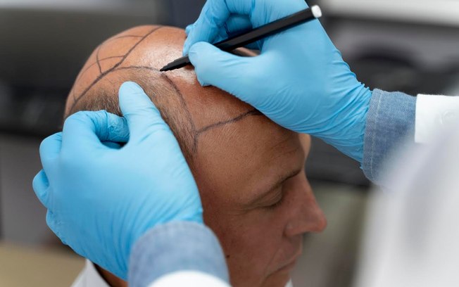 Técnica FUE redefine padrões de transplante capilar moderno