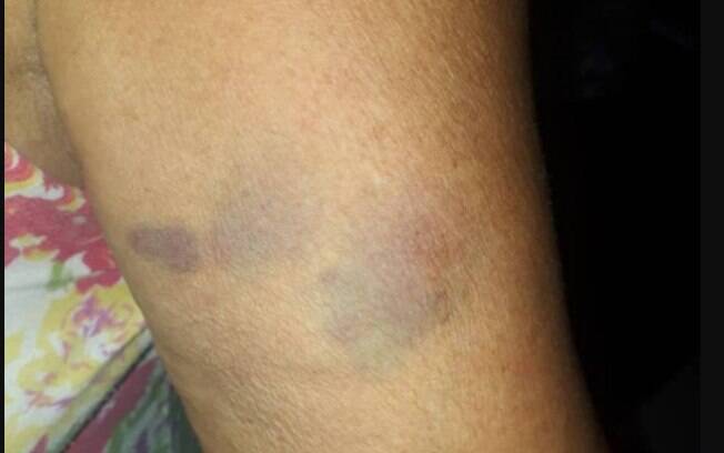 Mãe exibe hematomas após ser agredida pelo próprio filho Mãe exibe hematomas após ser agredida pelo próprio filho