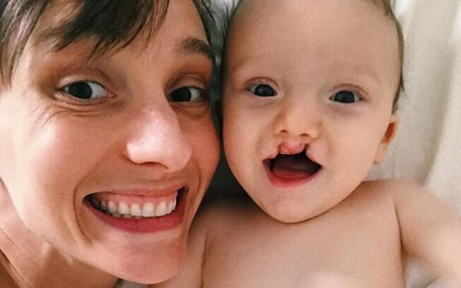 Desde que o primeiro filho nasceu, Isabel Hickmann usa as redes sociais para conscientizar sobre lábio leporino