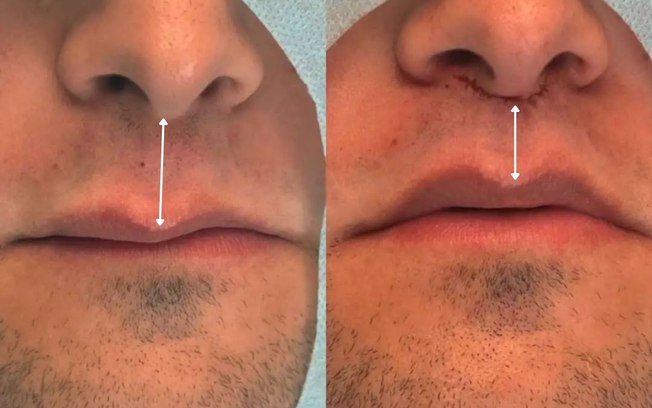 Lip Lift amplia opções de rejuvenescimento sem volume