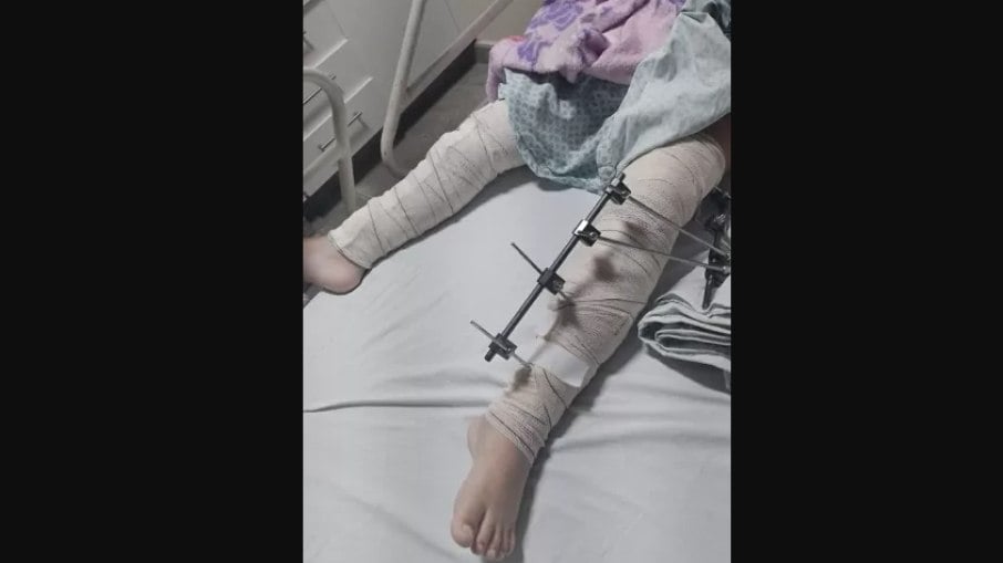Menina de 6 anos deu entrada em hospital da Paraíba para operar a perna esquerda, mas acabou com a perna direita operada após erro médico