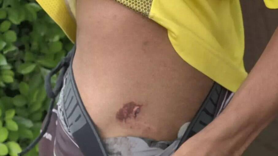 Adolescente mostra agressões na região da perna e nádegas.