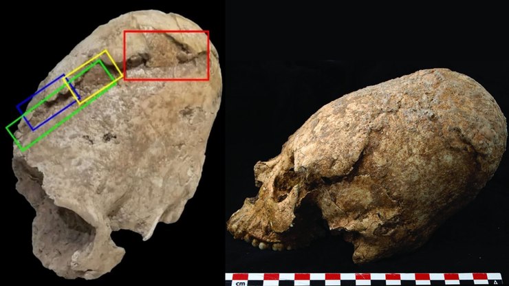 Crânio de 6 mil anos em formato de "cone" é encontrado no Irã