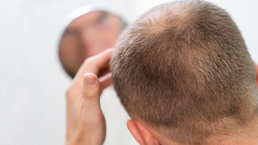 Coroa e entradas são as regiões mais afetadas pela calvície genética masculina