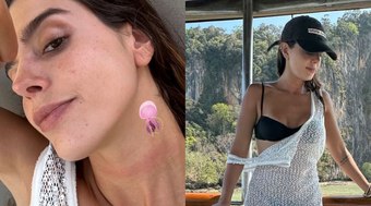 Giovanna Lancellotti é queimada por água-viva em viagem à Tailândia