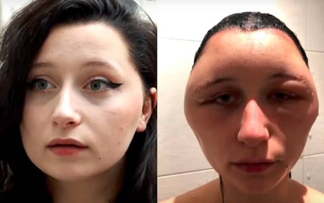 Outras mulheres tiveram reação alérgica ao uso de tintura de cabelo, como foi o caso de Estelle, que teve o rosto inchado