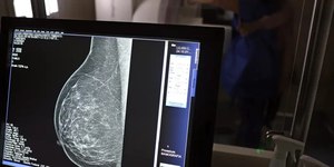 Rastreamento de câncer de mama agora é recomendado desde 40 anos
